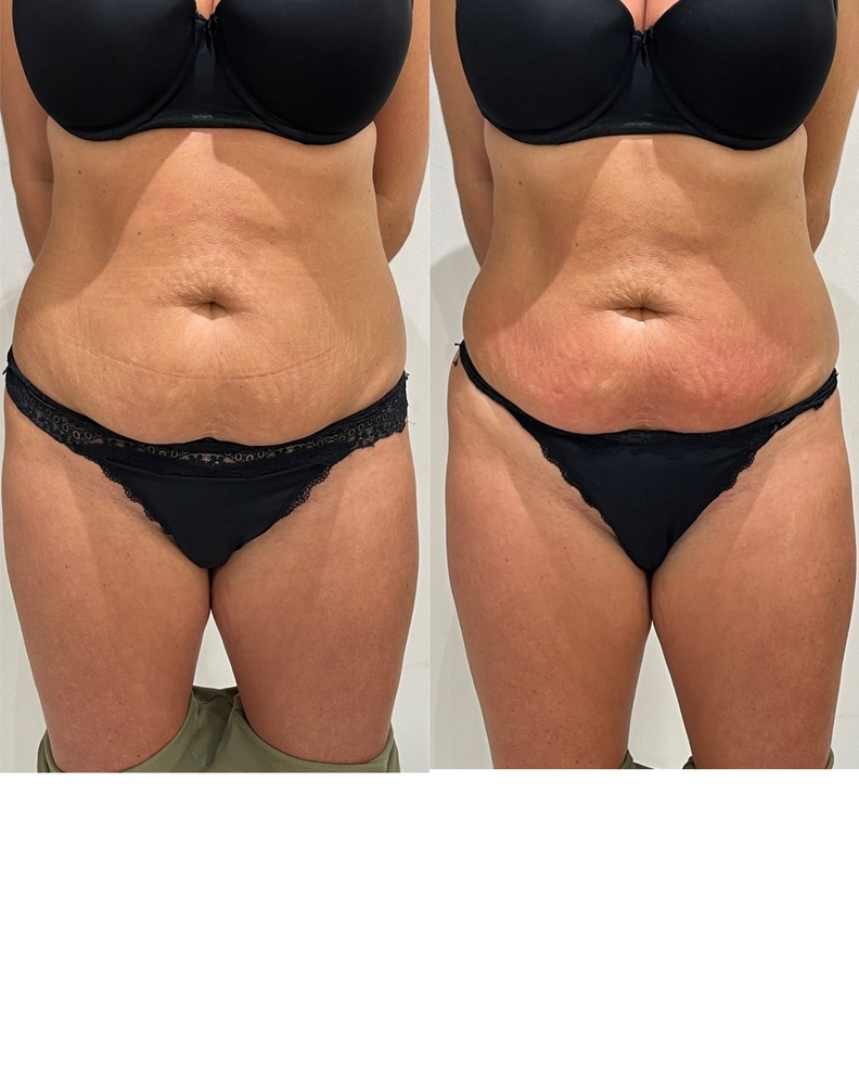 Stomach Toning LipoFirm