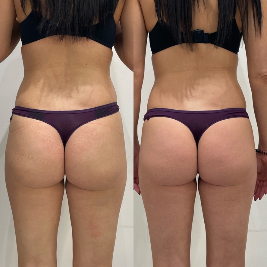 Bum Lift LipoFirm London