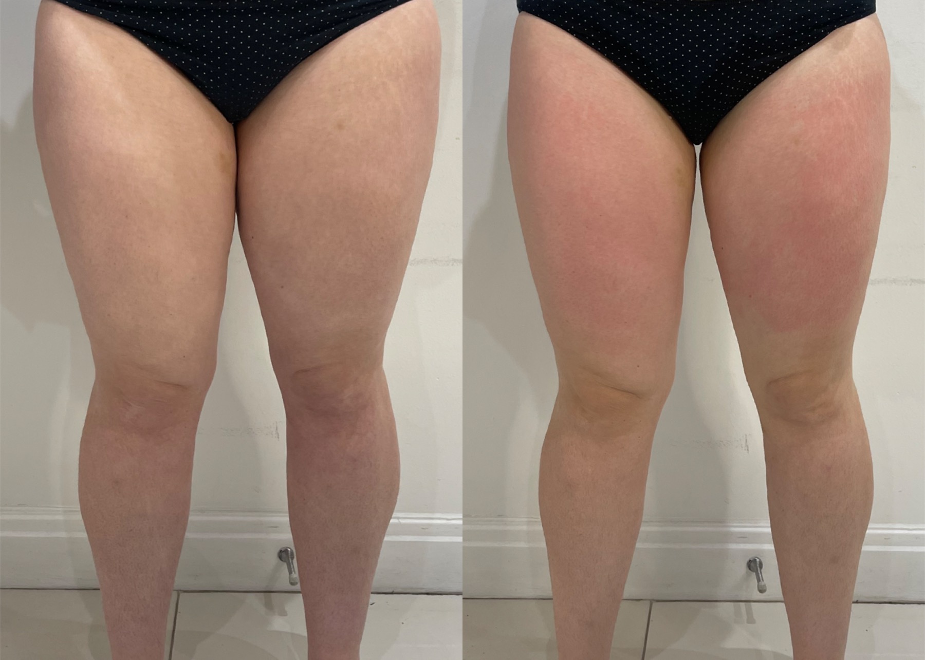 Legs LipoFirm London