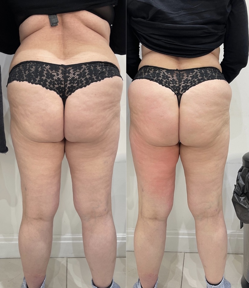 Bums & Thighs LipoFirm London