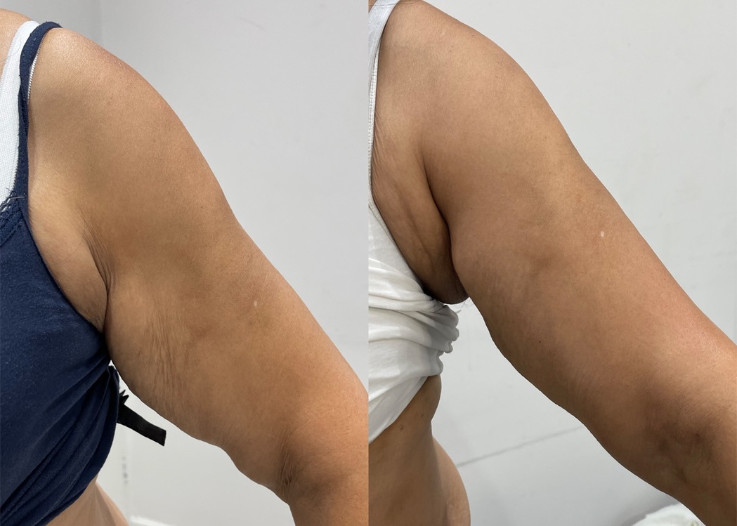 Arm Fat LipoFirm London