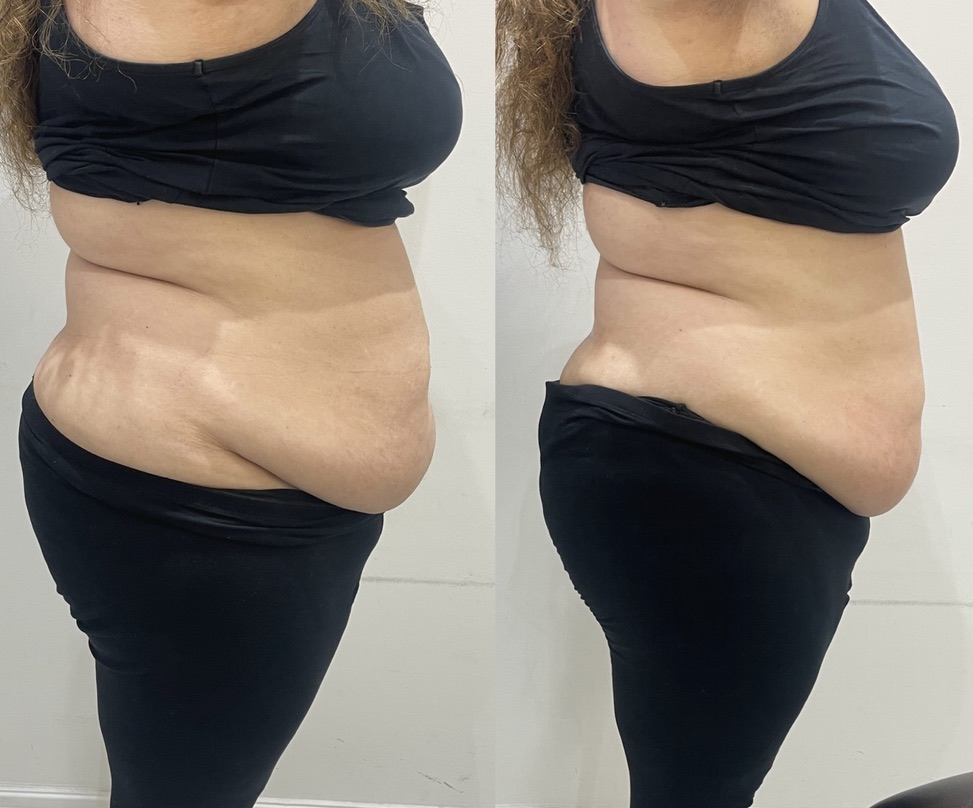 Mummy Tummy LipoFirm London