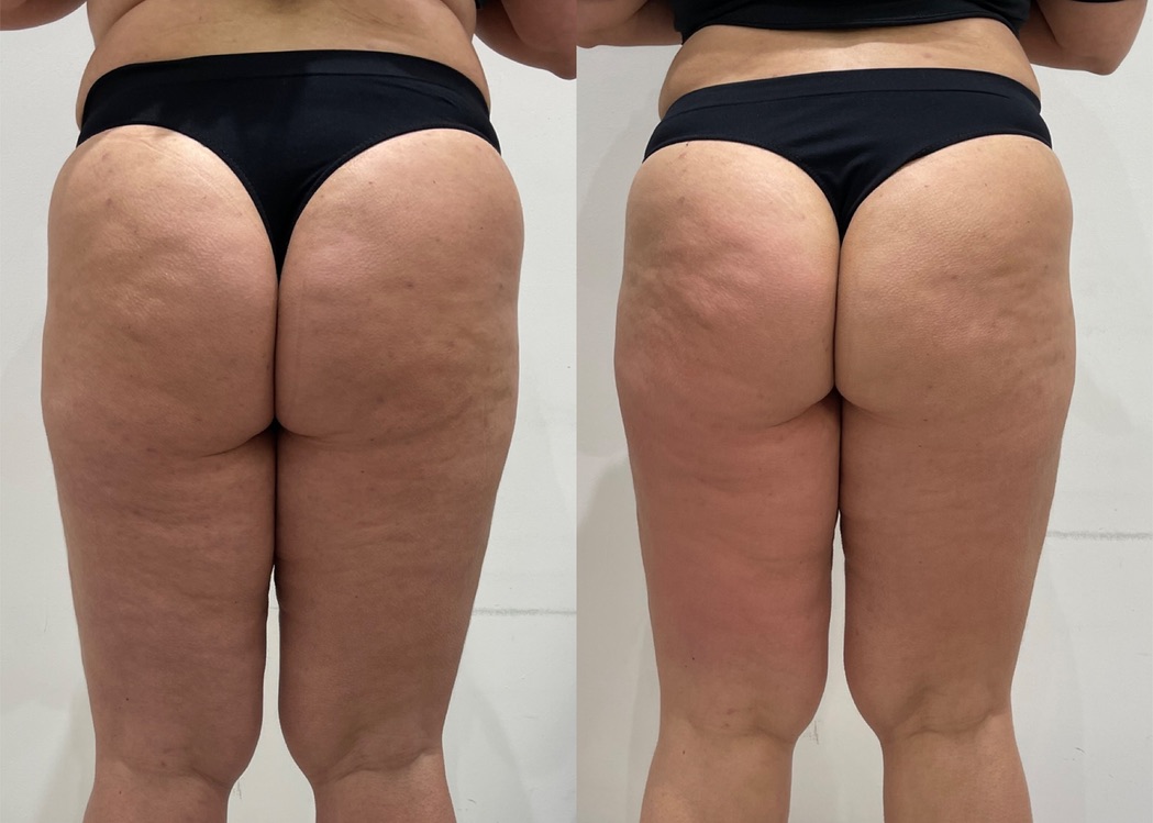 Cellulite reduction LipoFirm