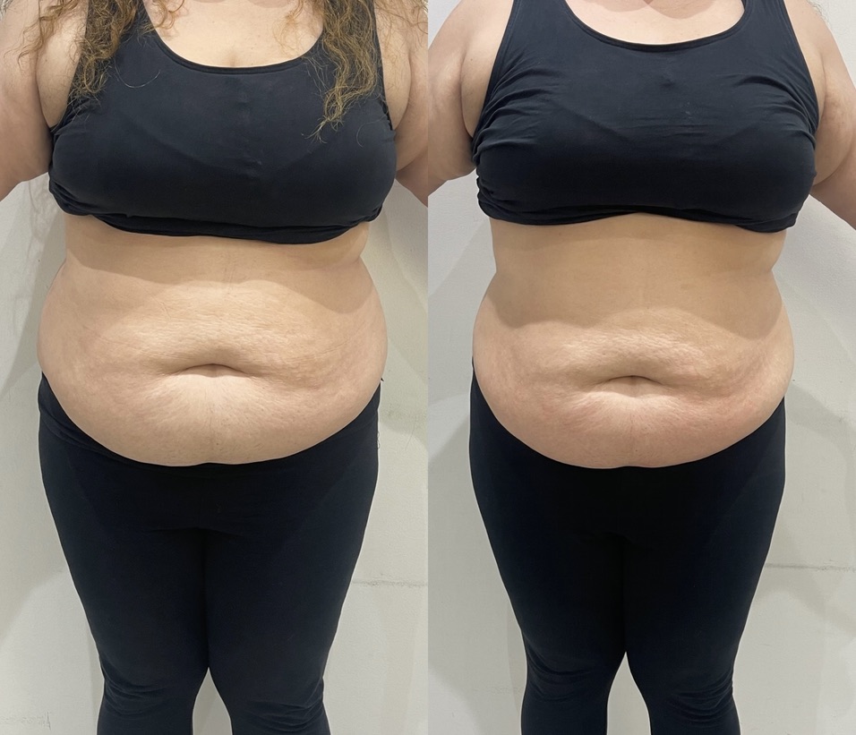 Mummy Tummy LipoFirm London