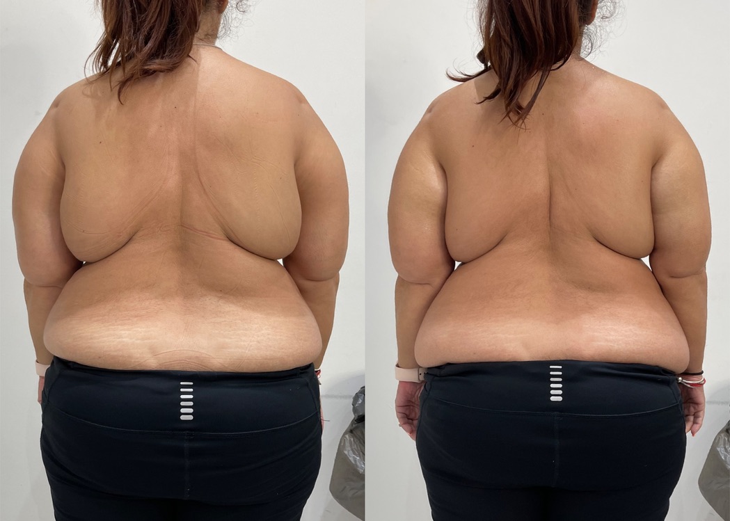 Bra Fat Reduction LipoFirm London