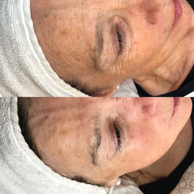 Hydro2Facial 2 Medium