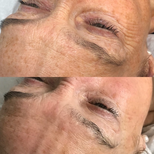 Hydro2Facial 3 Medium