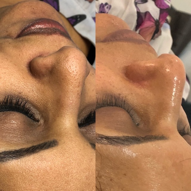 Hydro2Facial 5 Medium