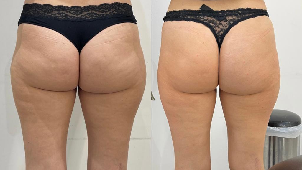 Bum Lift LipoFirm London