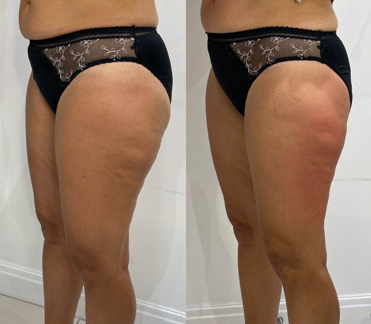 Cellulite Lipofirm London