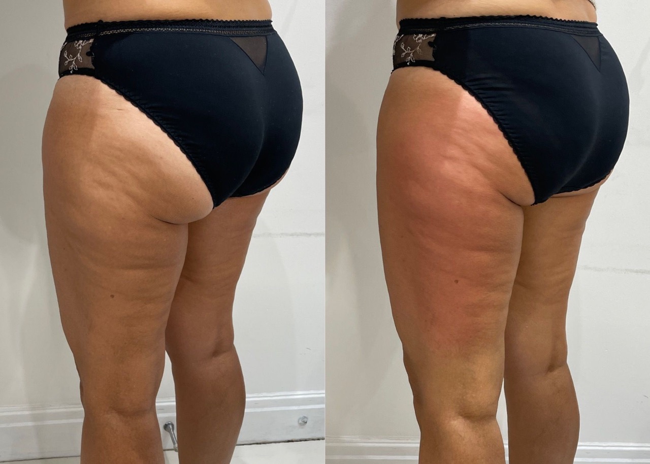 Cellulite Lipofirm London