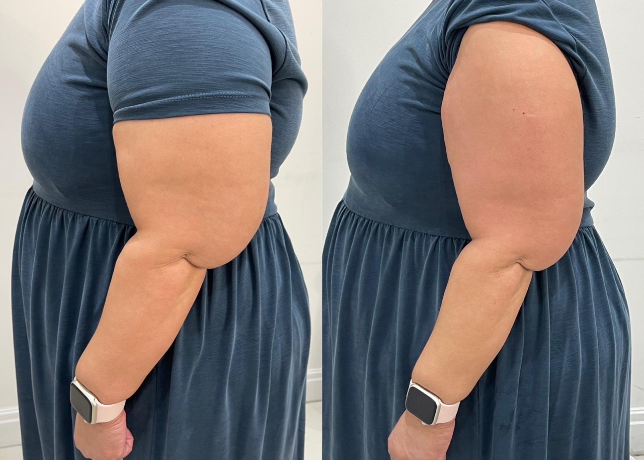 Arm Fat Reduction