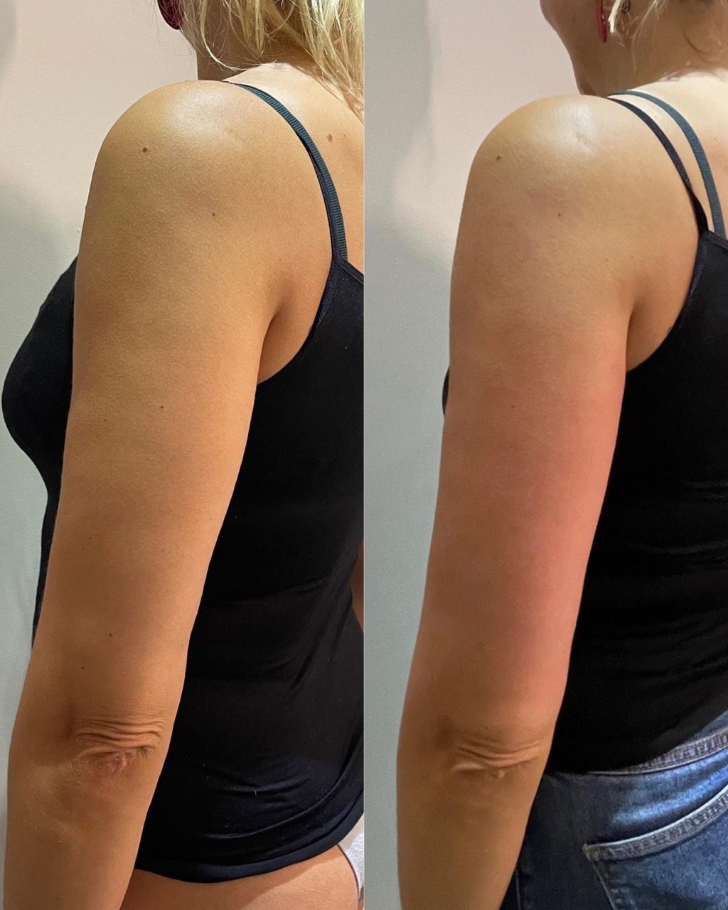 Arm Tonning LipoFirm London