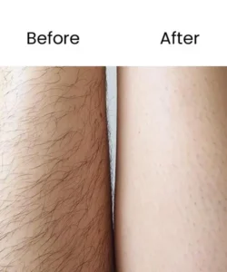 Laser Hair Removal Near West Finchley